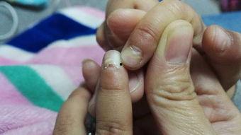指甲从根部脱落照片